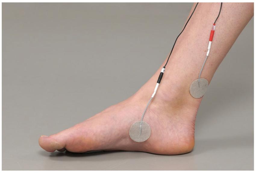 Stimolazione nervo tibiale tramite elettrodi